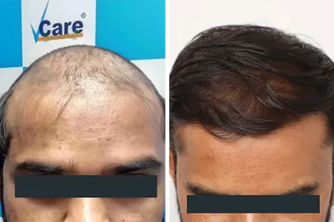 Hair rejuvation therapy before photo in VCare